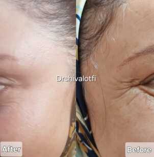 بوتاکس خطوط پنجه کلاغی