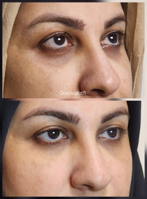 نیم سی سی ژل زیر چشم